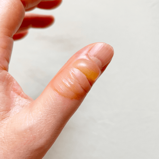  Best Home Remedies to Quickly Heal Minor Burns & Blisters